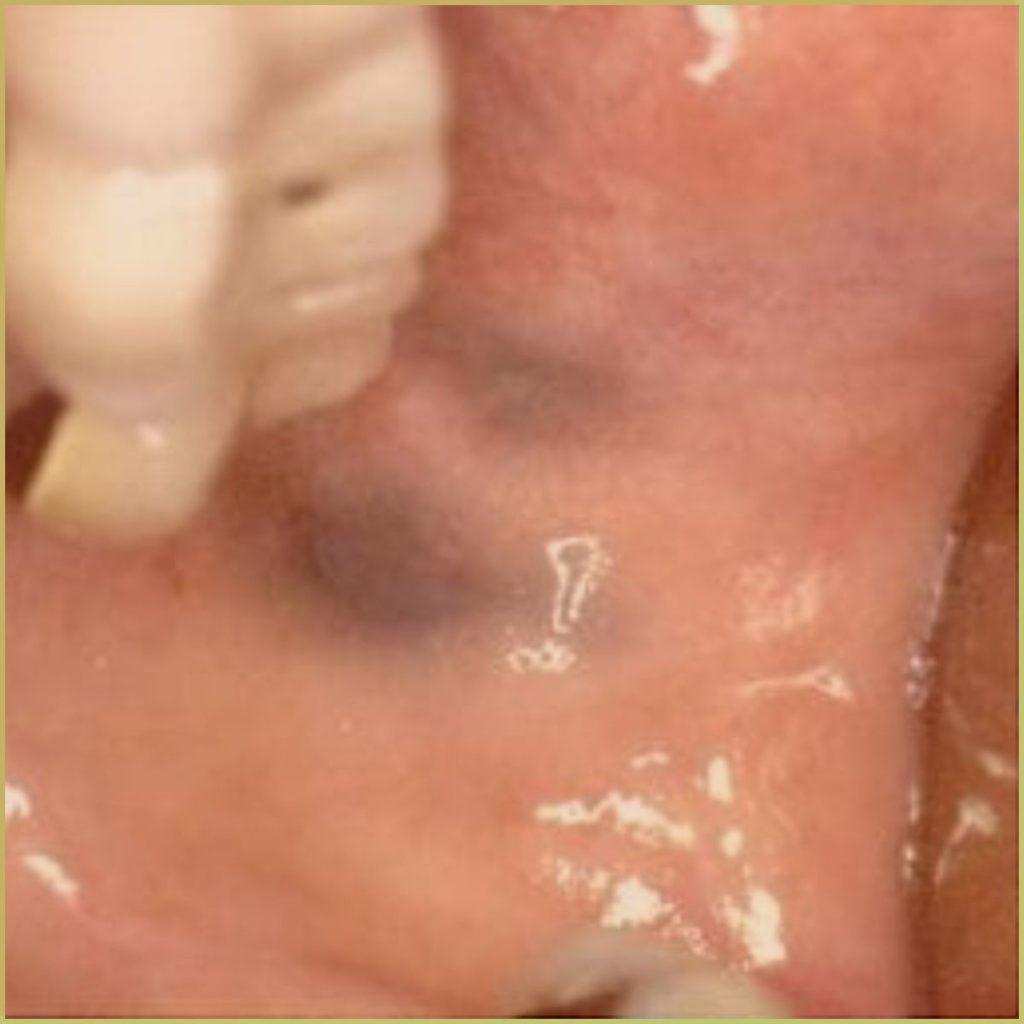 Melanoma 6 1024x1024 1