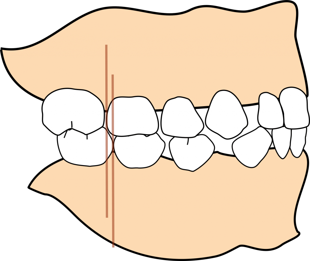 Mesial step 1024x863 1