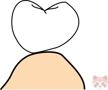 Modified rIdge lap pontic