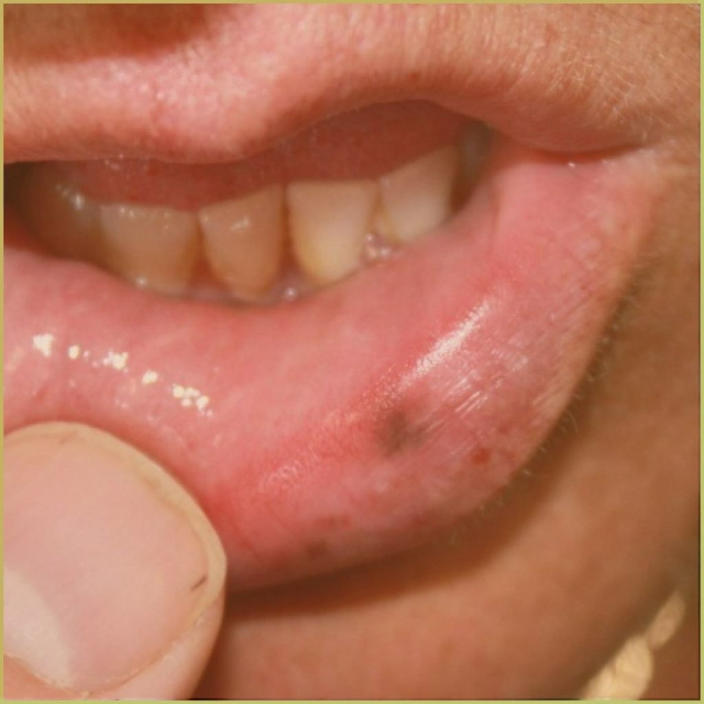 Mucosal Melanotic Macules 1 1024x1024 1