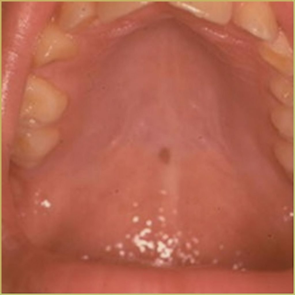 Mucosal Melanotic Macules 3 1024x1024 1