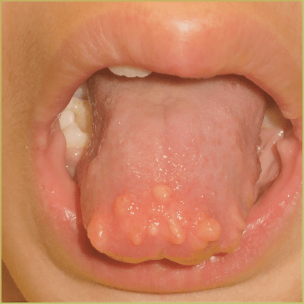 Mucosal Neuroma 1 1024x1024 1