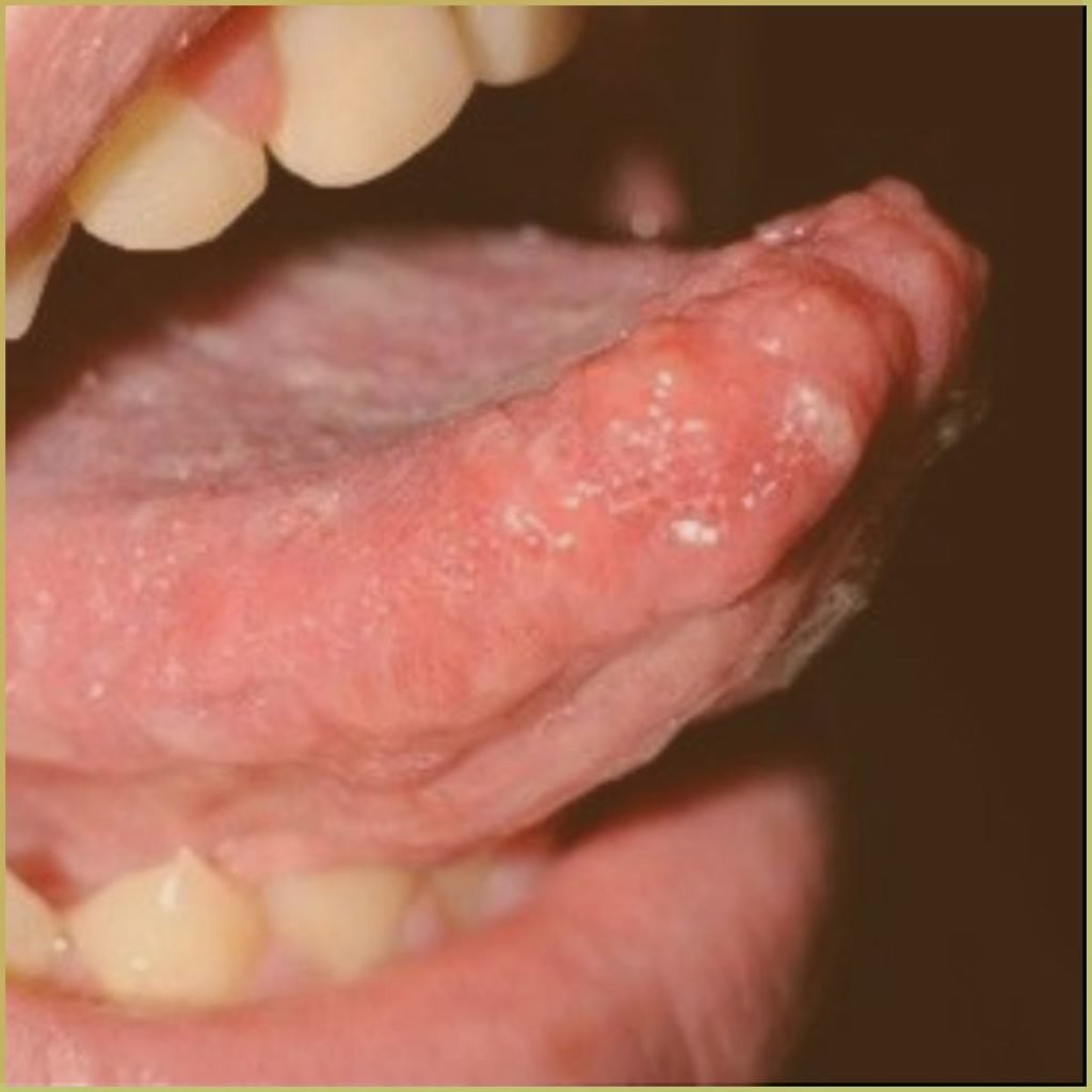 Mucosal Neuroma 2 1024x1024 1