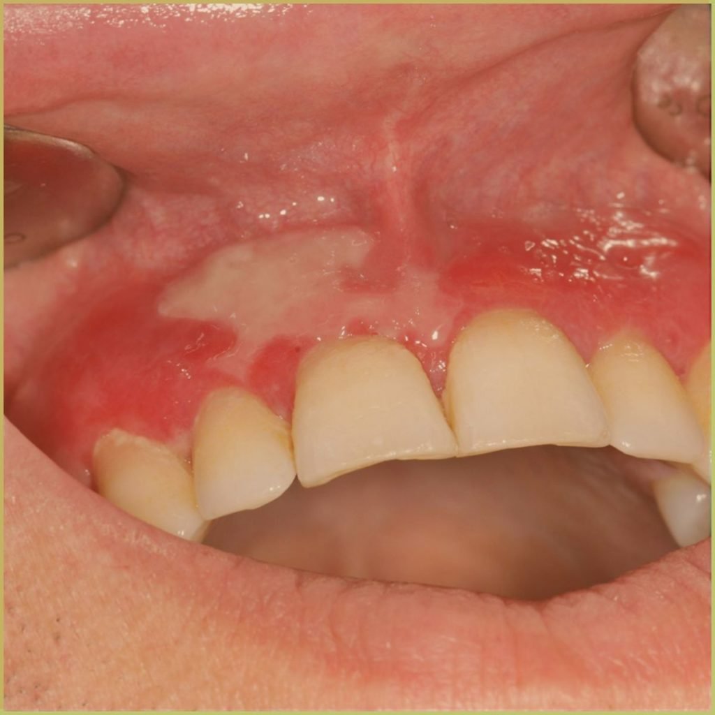 Mucous Membrane Pemphigoid 1 1024x1024 1