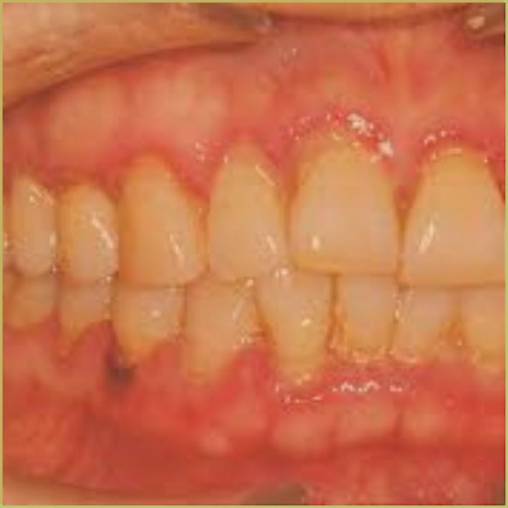 Mucous Membrane Pemphigoid 2 1024x1024 1