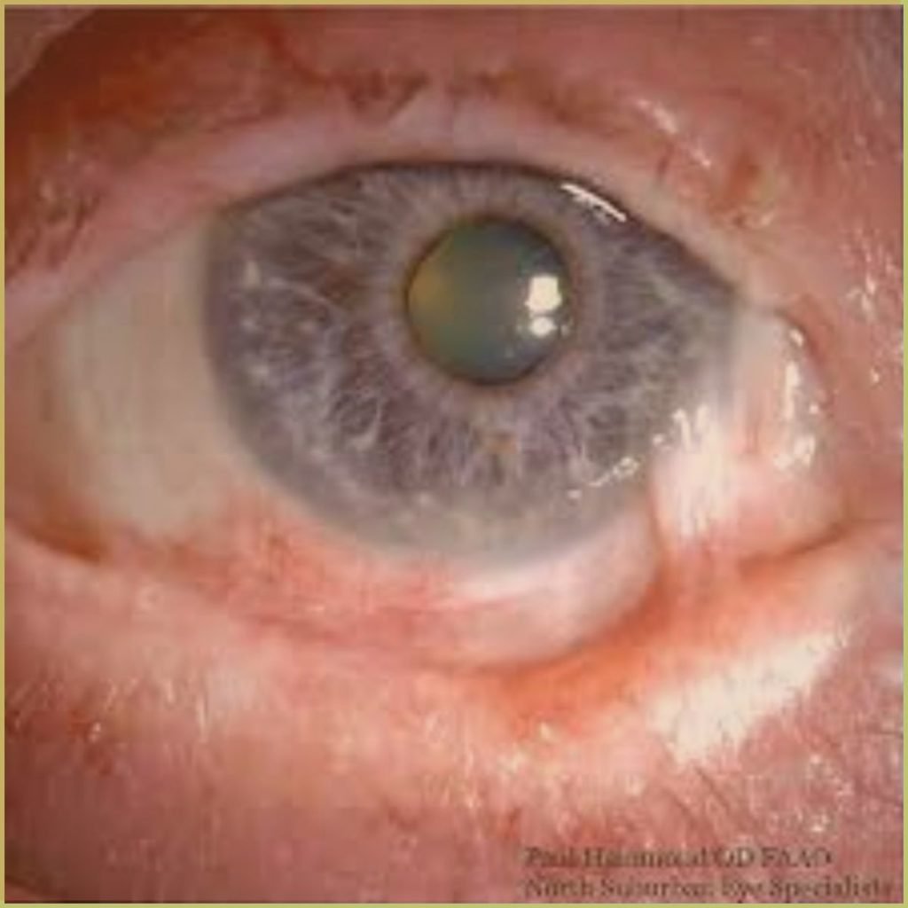 Mucous Membrane Pemphigoid 3 1024x1024 1