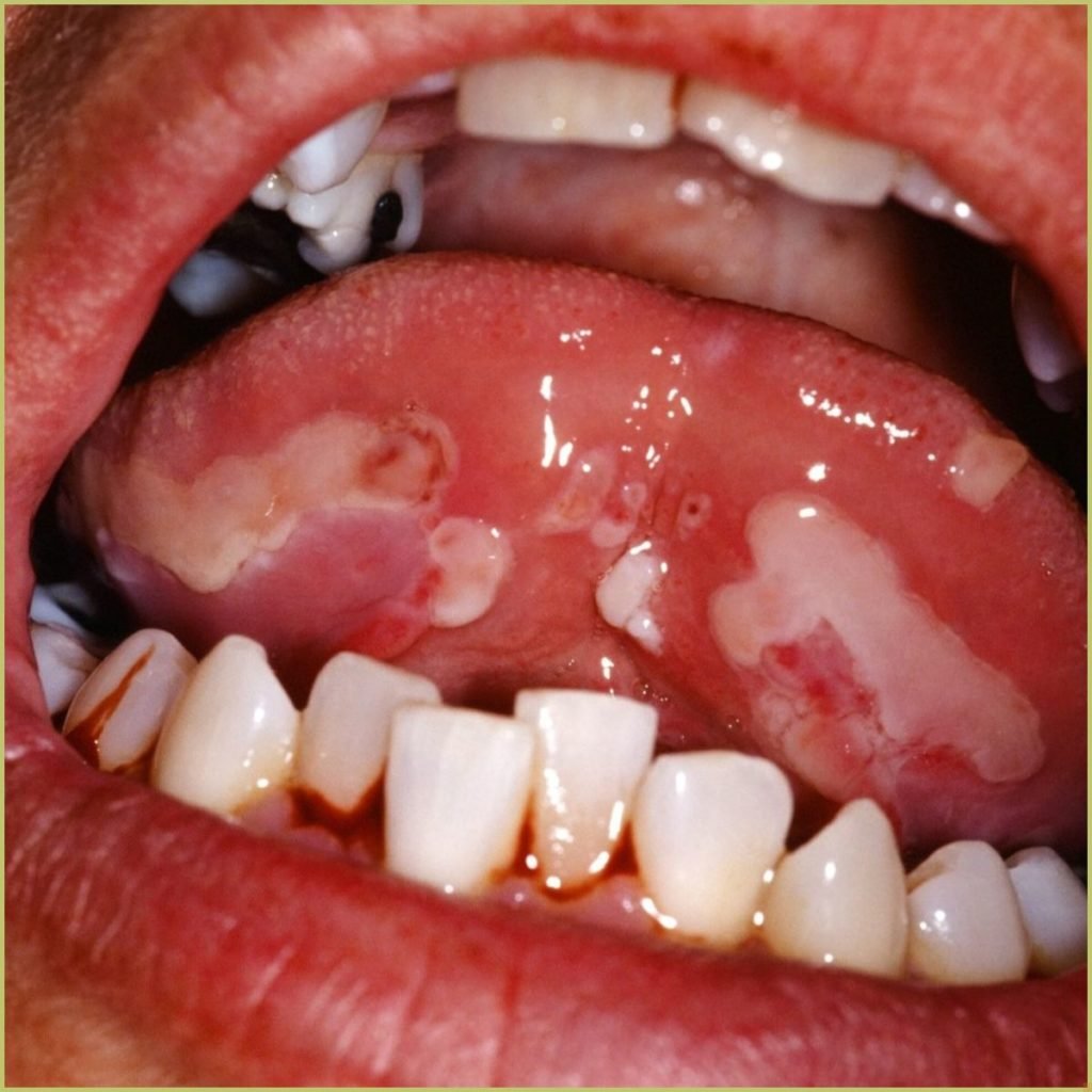 Mucous Membrane Pemphigoid 4 1 1024x1024 1