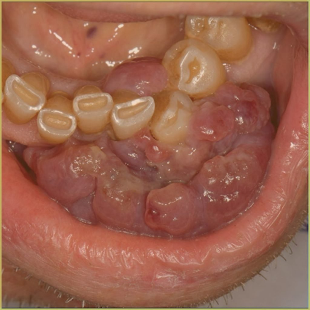 Multiple myeloma 1 1024x1024 1