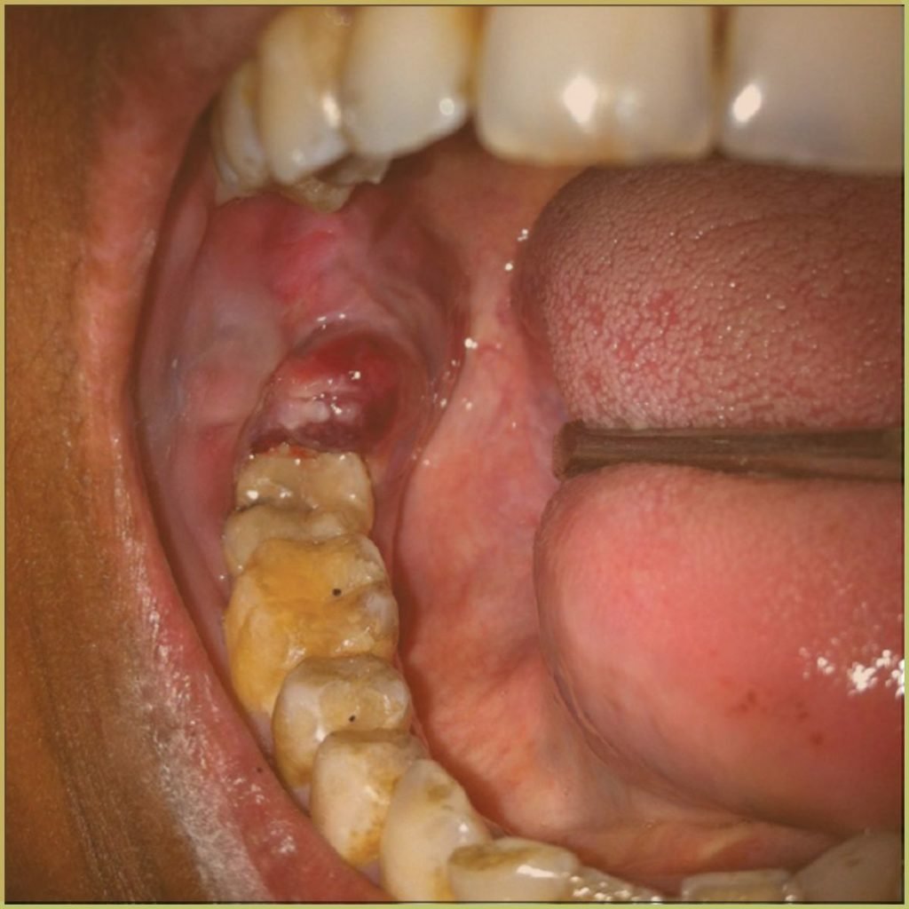 Multiple myeloma 3 1024x1024 1