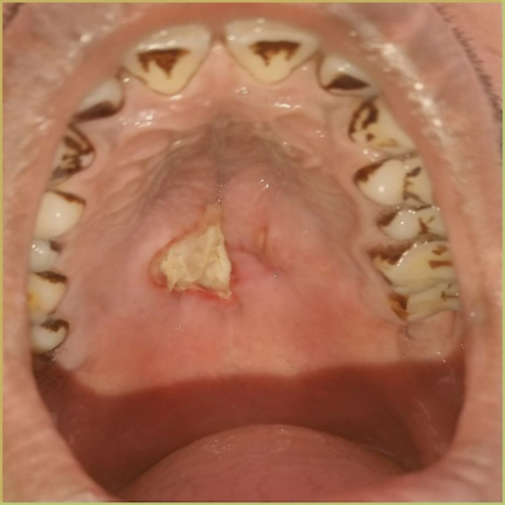 Necrotizing Sialometaplasia 1 1024x1024 2