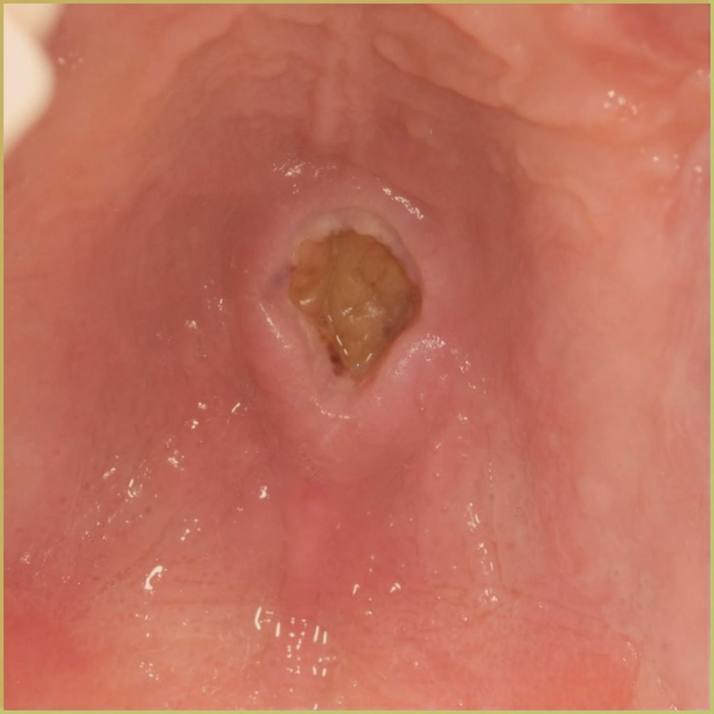 Necrotizing Sialometaplasia 3 1024x1024 1