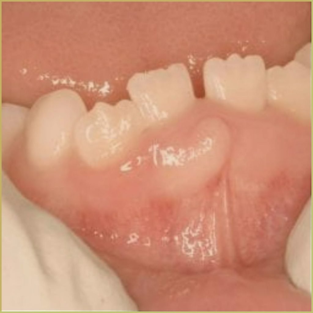 Neurofibroma 1 1024x1024 1