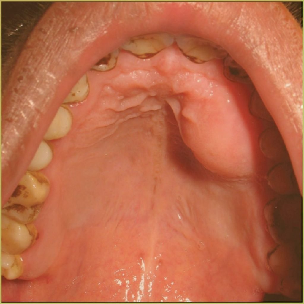 Neurofibroma 2 1024x1024 1