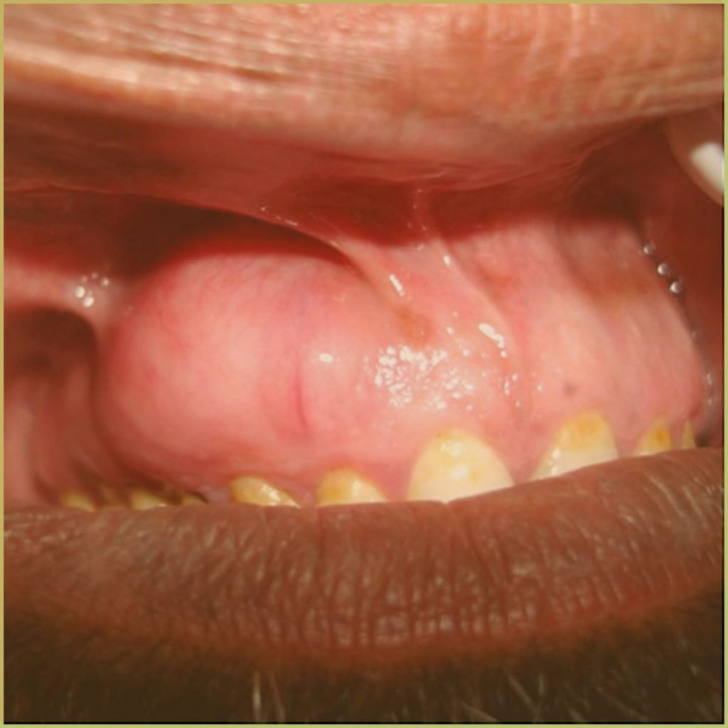 Neurofibroma 3 1024x1024 1
