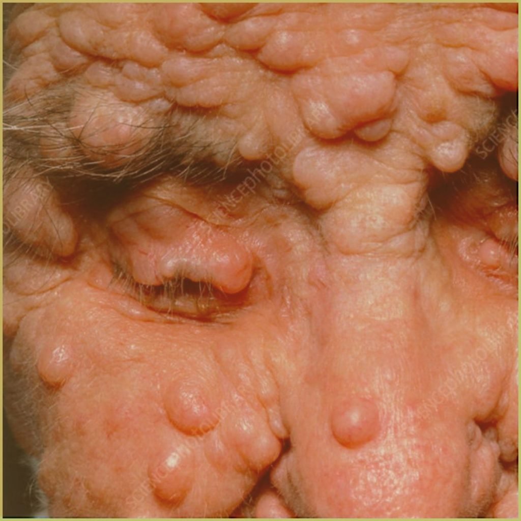 Neurofibroma 4 1024x1024 1