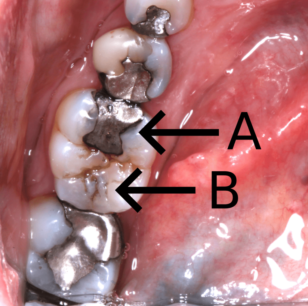 Occlusal caries 2 1024x1016 1