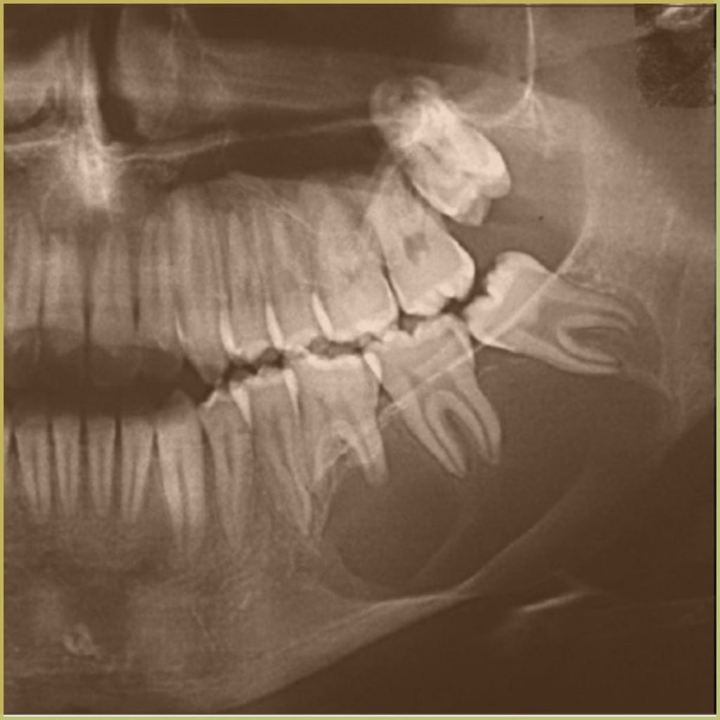 Odontogenic Keratocysts 3 1024x1024 1