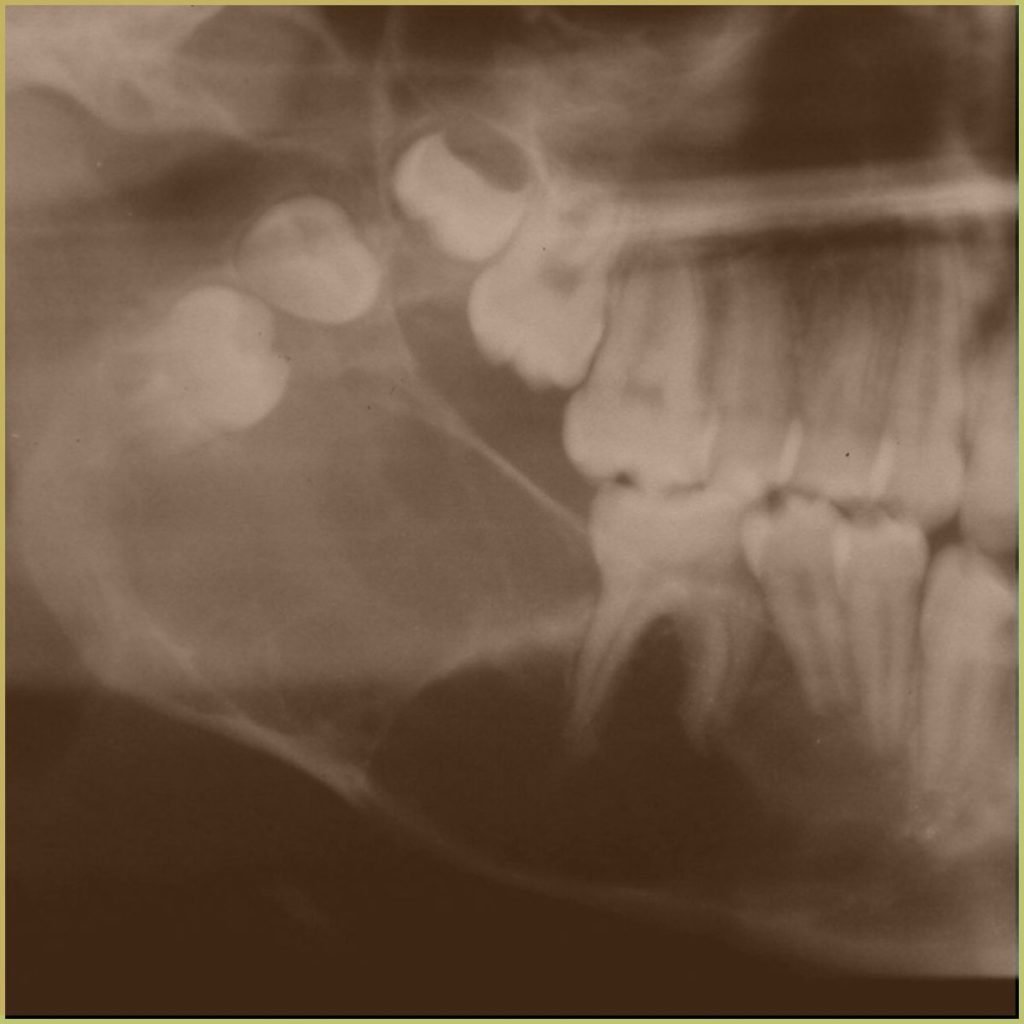 Odontogenic Myxoma 1 1024x1024 1