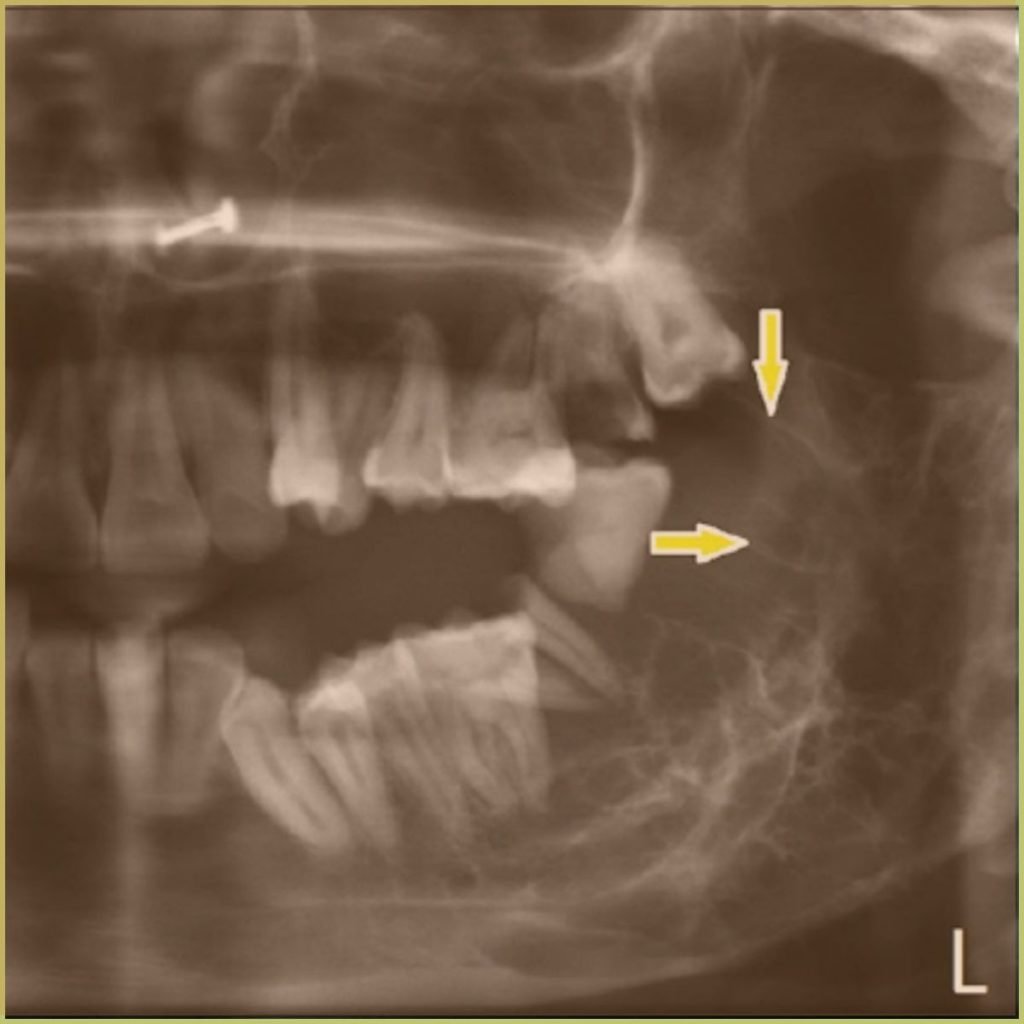 Odontogenic Myxoma 2 1024x1024 1