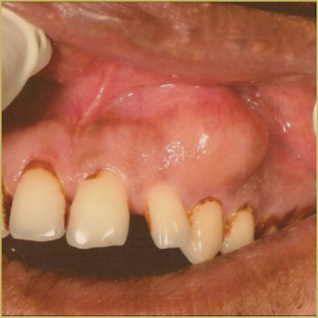 Odontogenic Myxoma 3 1024x1024 1