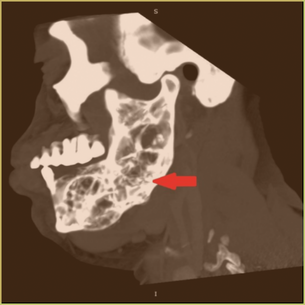 Odontogenic Myxoma 4 1024x1024 1