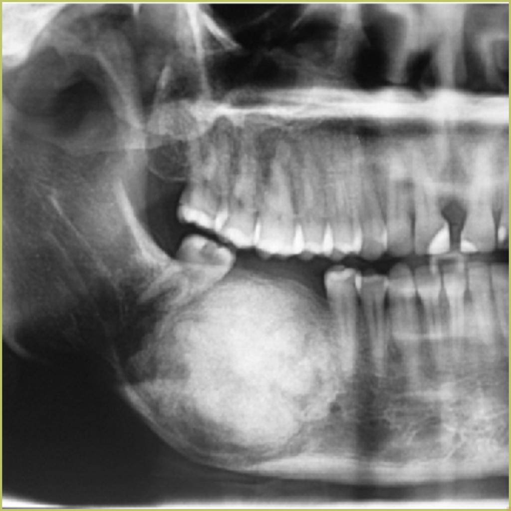 Ossifying Fibroma 1 1024x1024 1