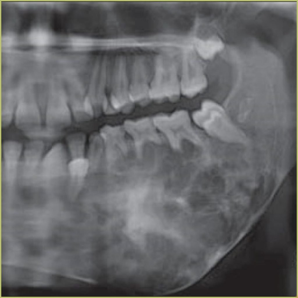 Ossifying Fibroma 2 1024x1024 1