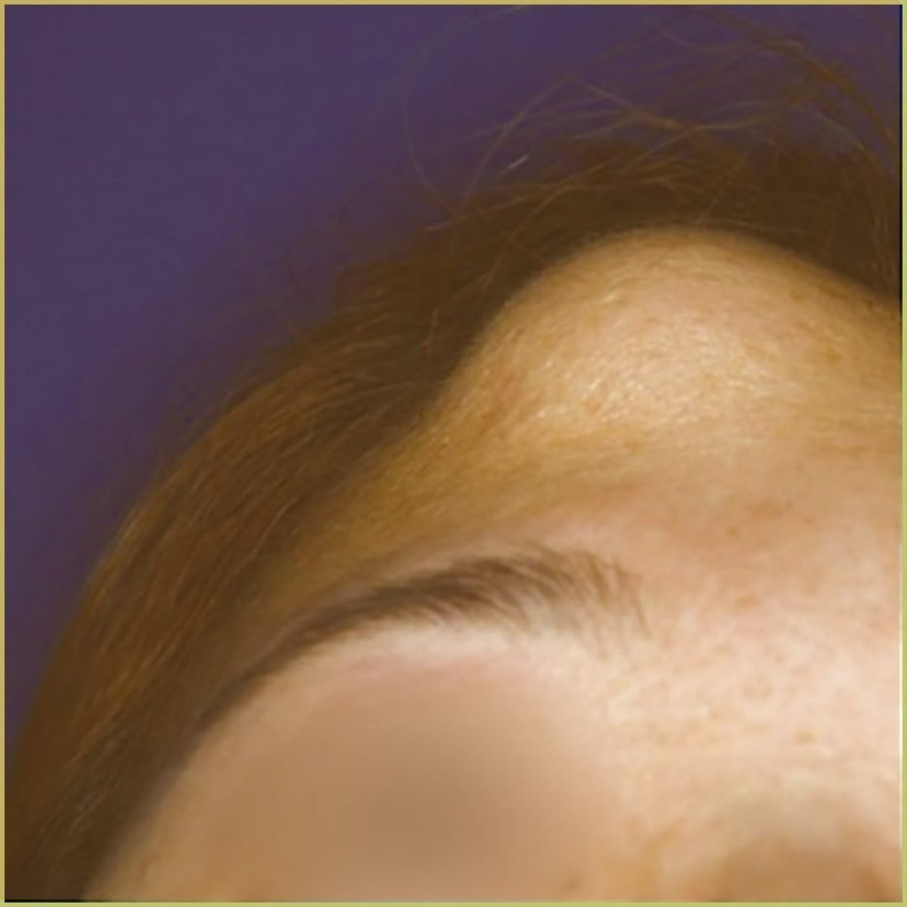 Osteoma 1 1024x1024 1