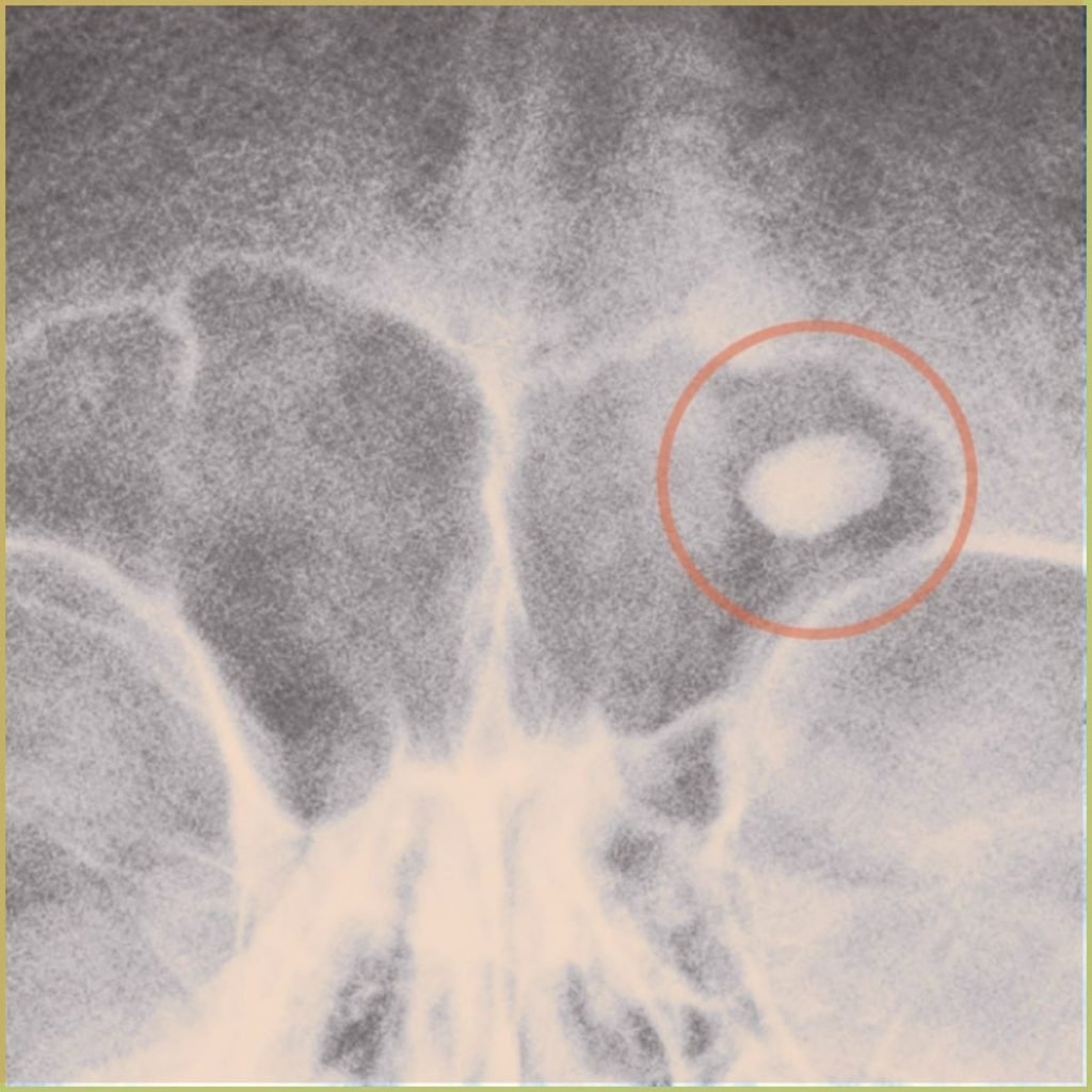 Osteoma 2 1024x1024 1