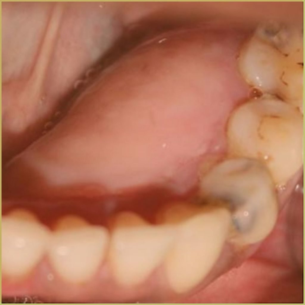 Osteoma 3 1024x1024 1