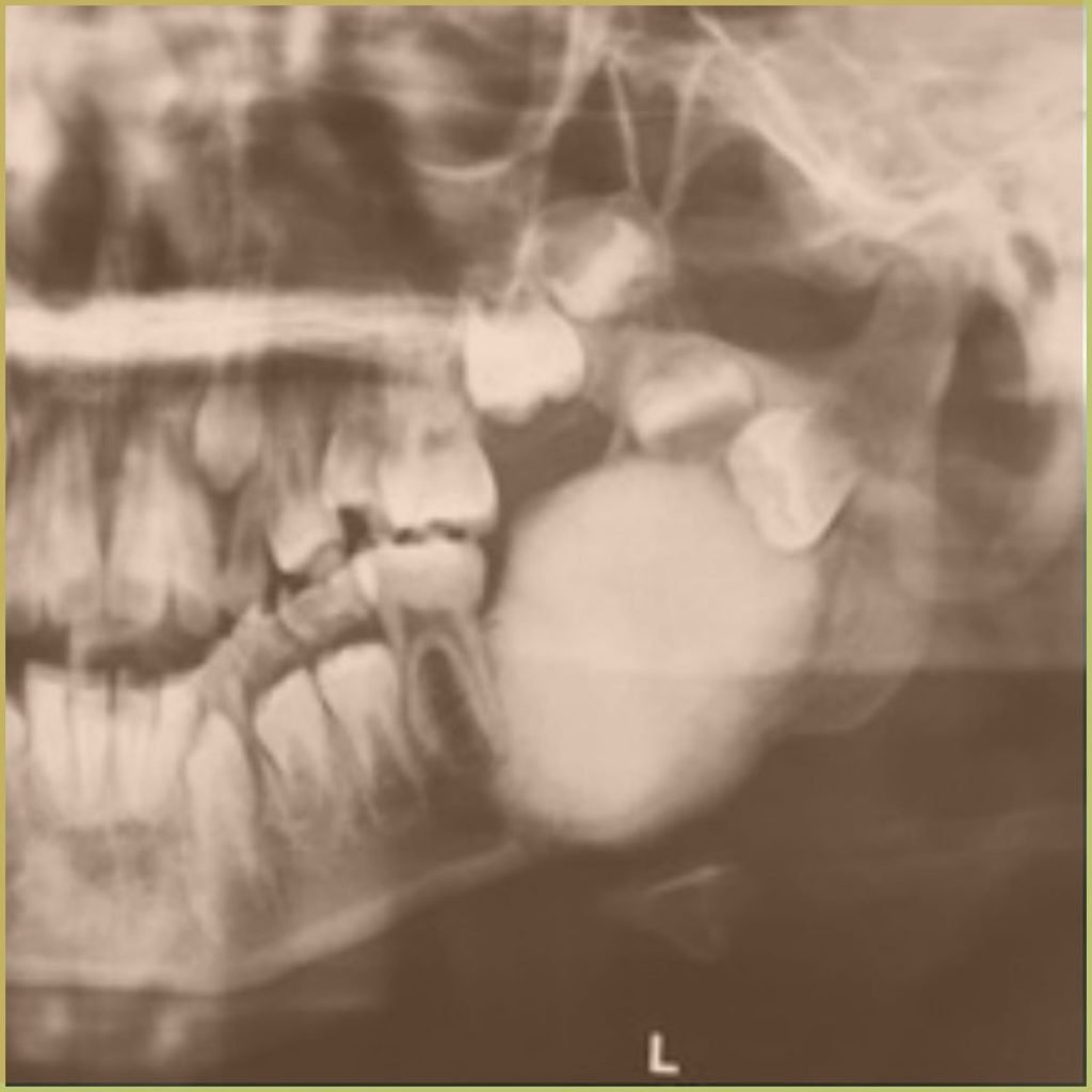 Osteoma 4 1024x1024 1