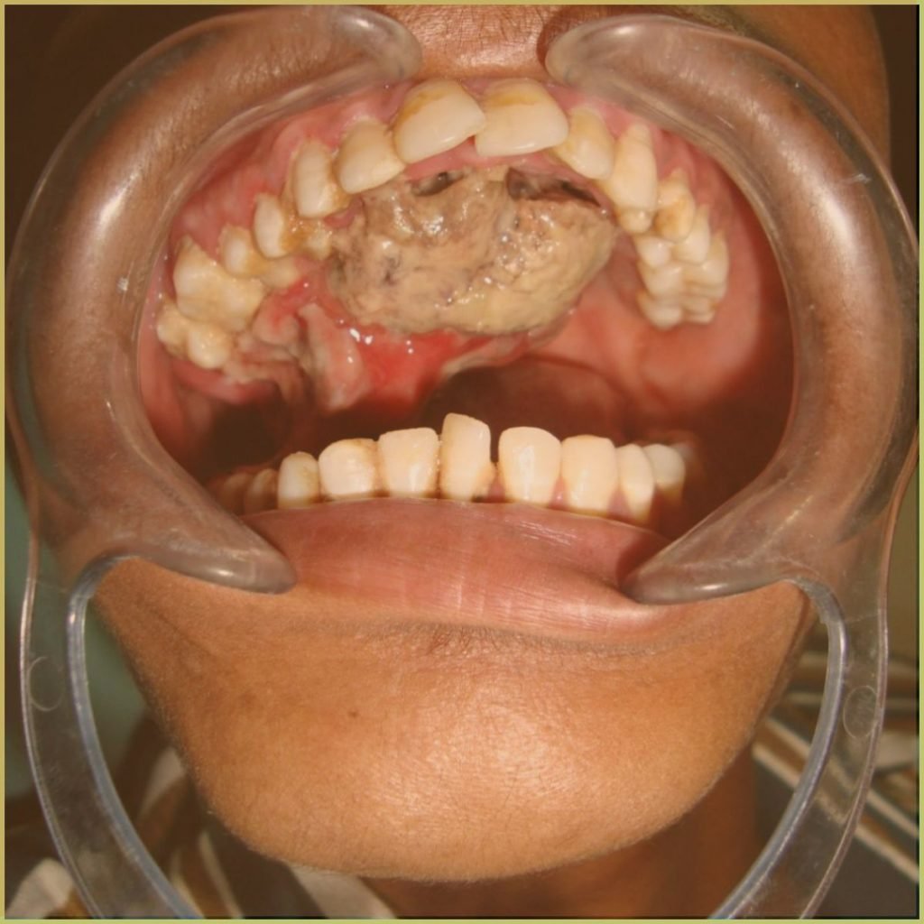 Osteosarcoma 1 1024x1024 1
