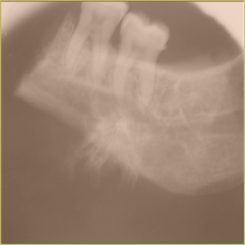 Osteosarcoma 2 1024x1024 1