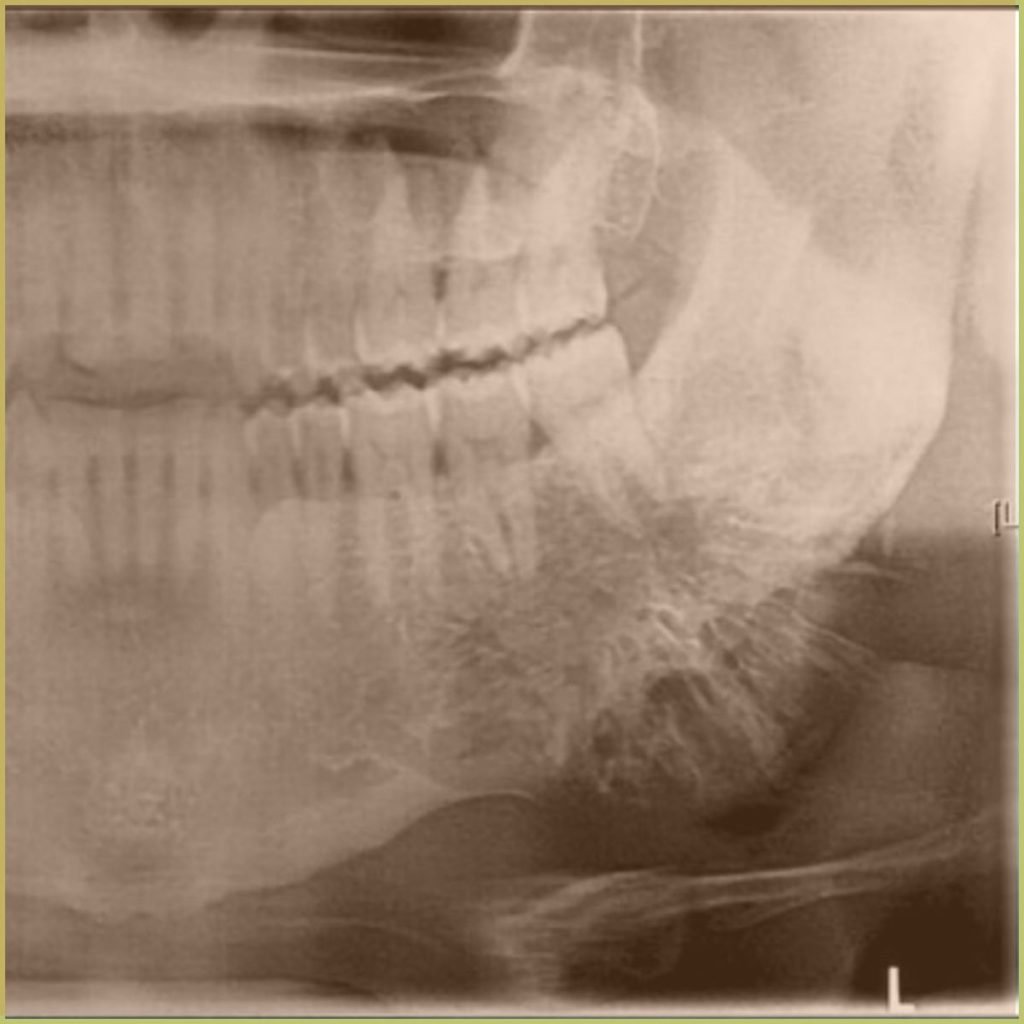 Osteosarcoma 3 1024x1024 1