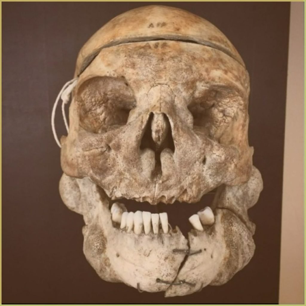 Pagets Disease 1024x1024 1