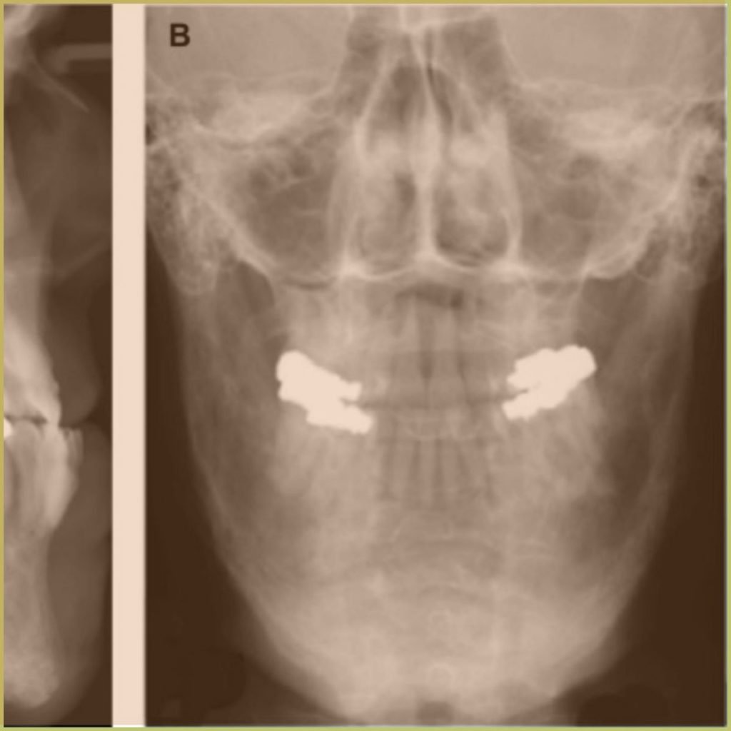 Pagets Disease 2 1024x1024 1