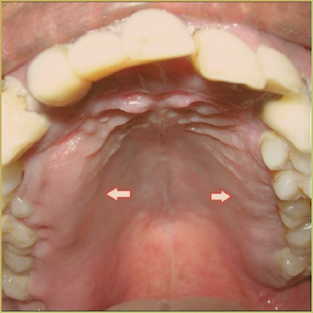Pagets Disease 3 1024x1024 1