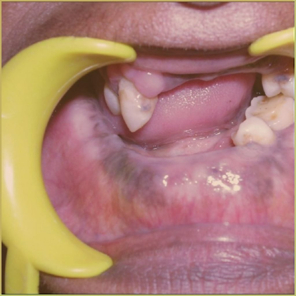 Pagets Disease 4 1024x1024 1