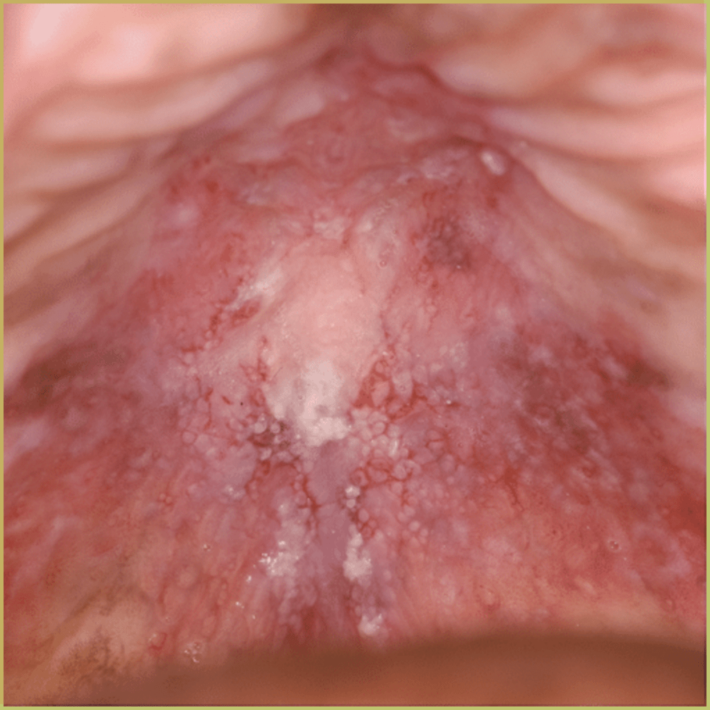 Papillary Hyperplasia 1 1024x1024 1