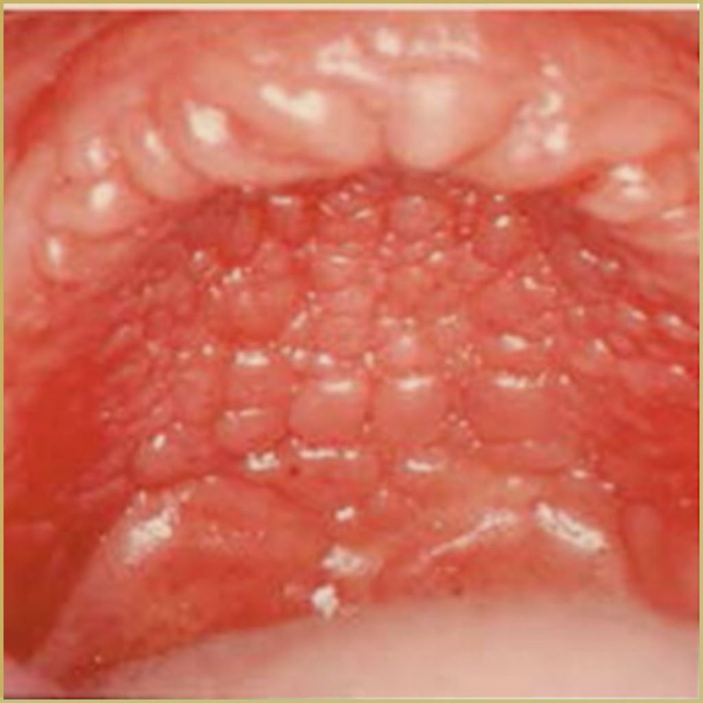 Papillary Hyperplasia 2 1024x1024 1