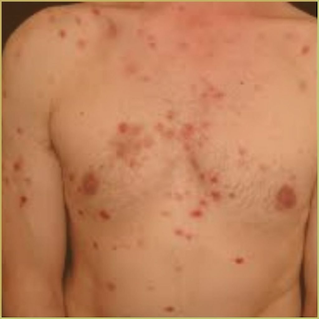 Pemphigus Vulgaris 1 1024x1024 1