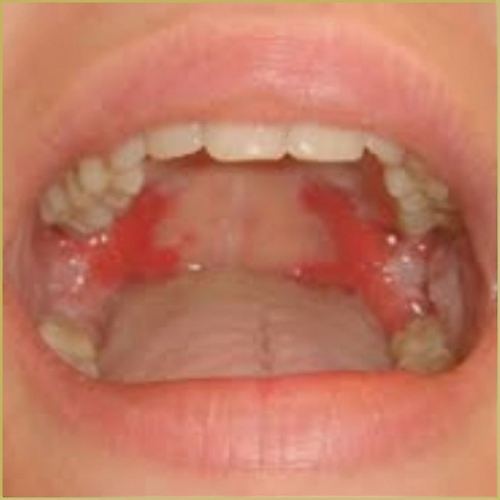 Pemphigus Vulgaris 2 1024x1024 1