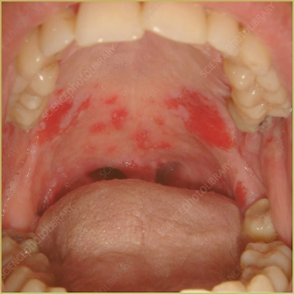 Pemphigus Vulgaris 3 1024x1024 1