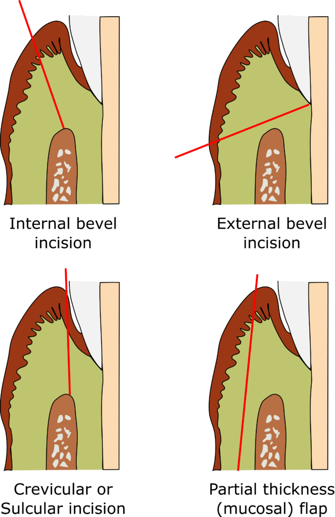 Periodontal incisions 1 664x1024 1