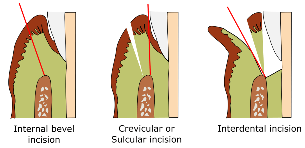 Periodontal incisions 2 3 1024x497 1