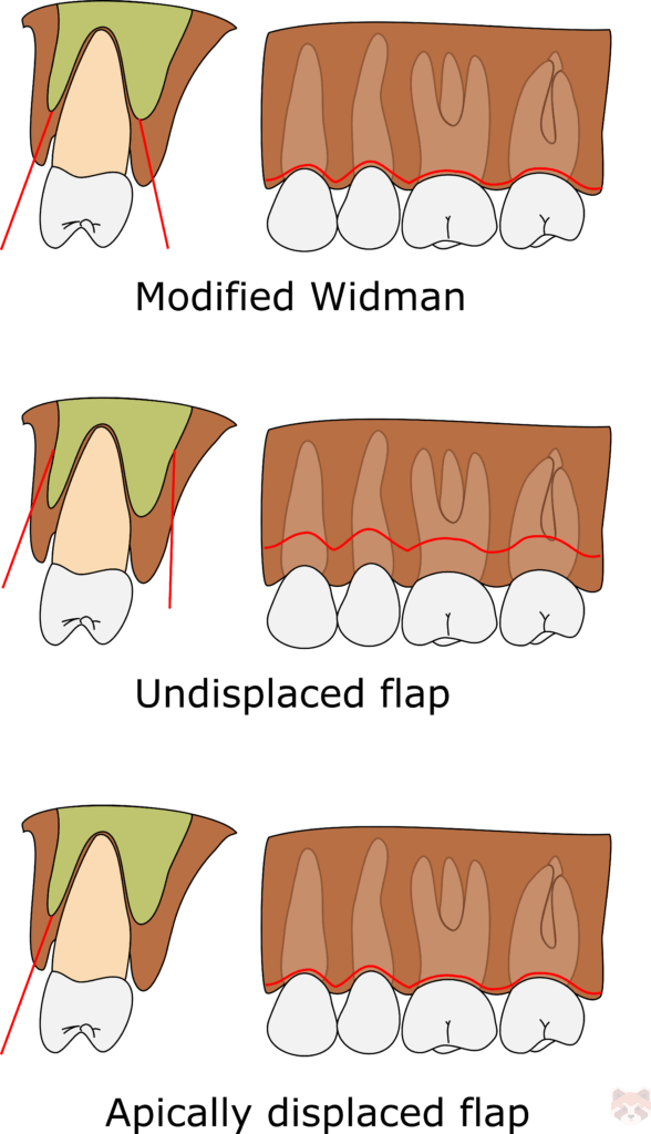 Periodontal incisions 3 588x1024 1