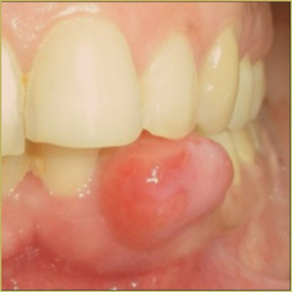 Peripheral Ossifying Fibroma 2 1024x1024 1