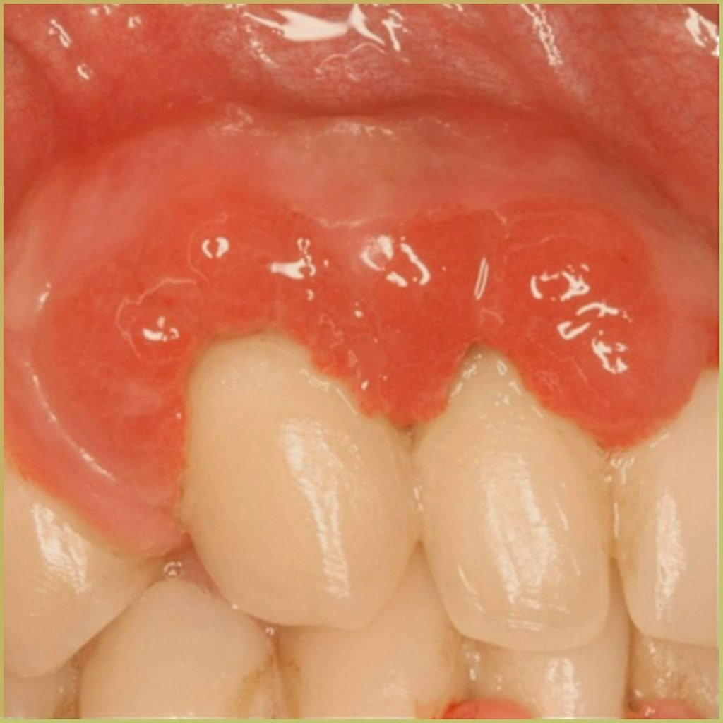 Plasma Cell Gingivitis 2 1024x1024 1