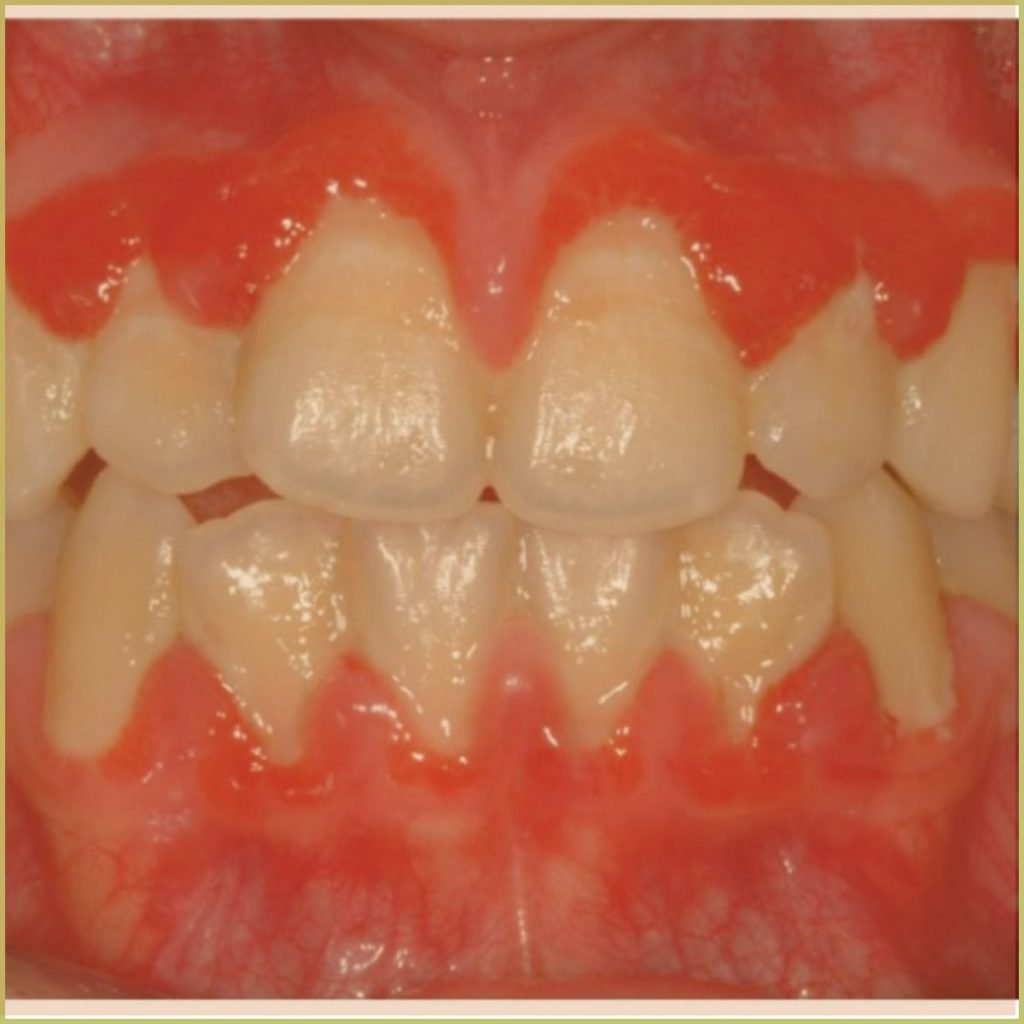 Plasma Cell Gingivitis 3 1024x1024 1