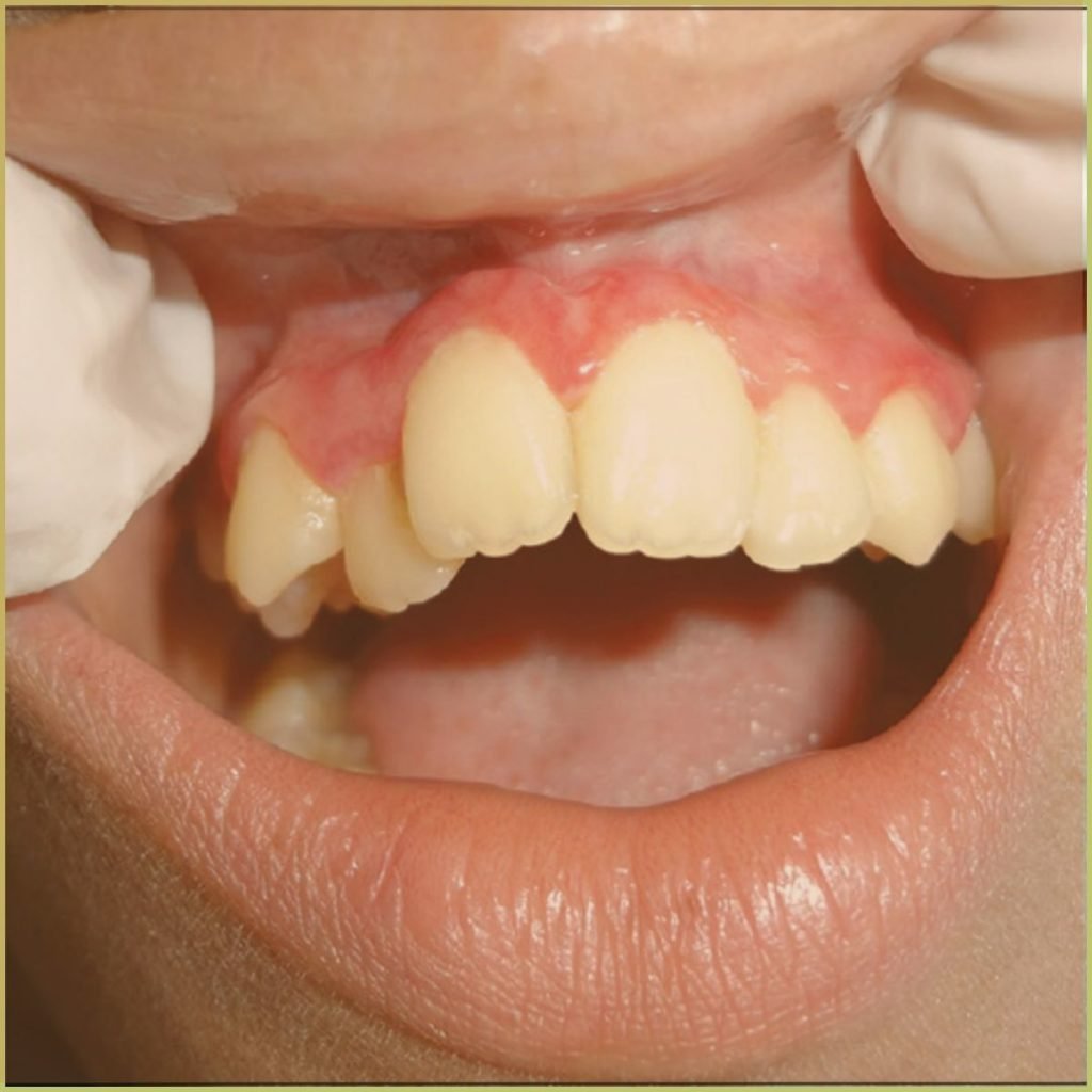 Plasma Cell Gingivitis 4 1024x1024 1